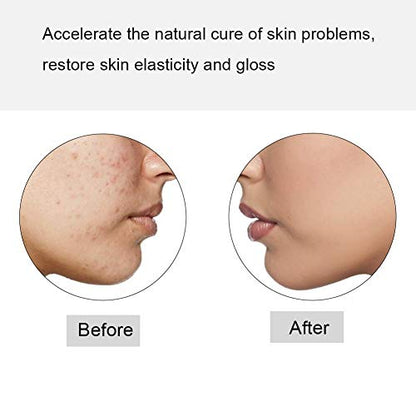Light Therapy Acne Wand