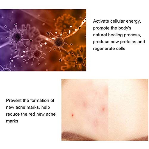 Light Therapy Acne Wand